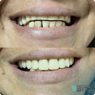 antes-depois-3