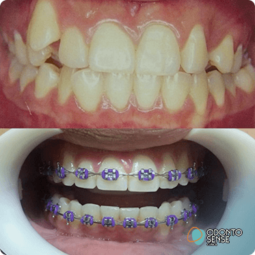 antes-depois-6
