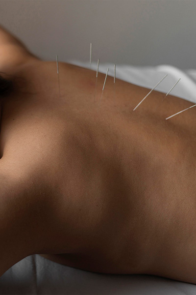 Acupuntura