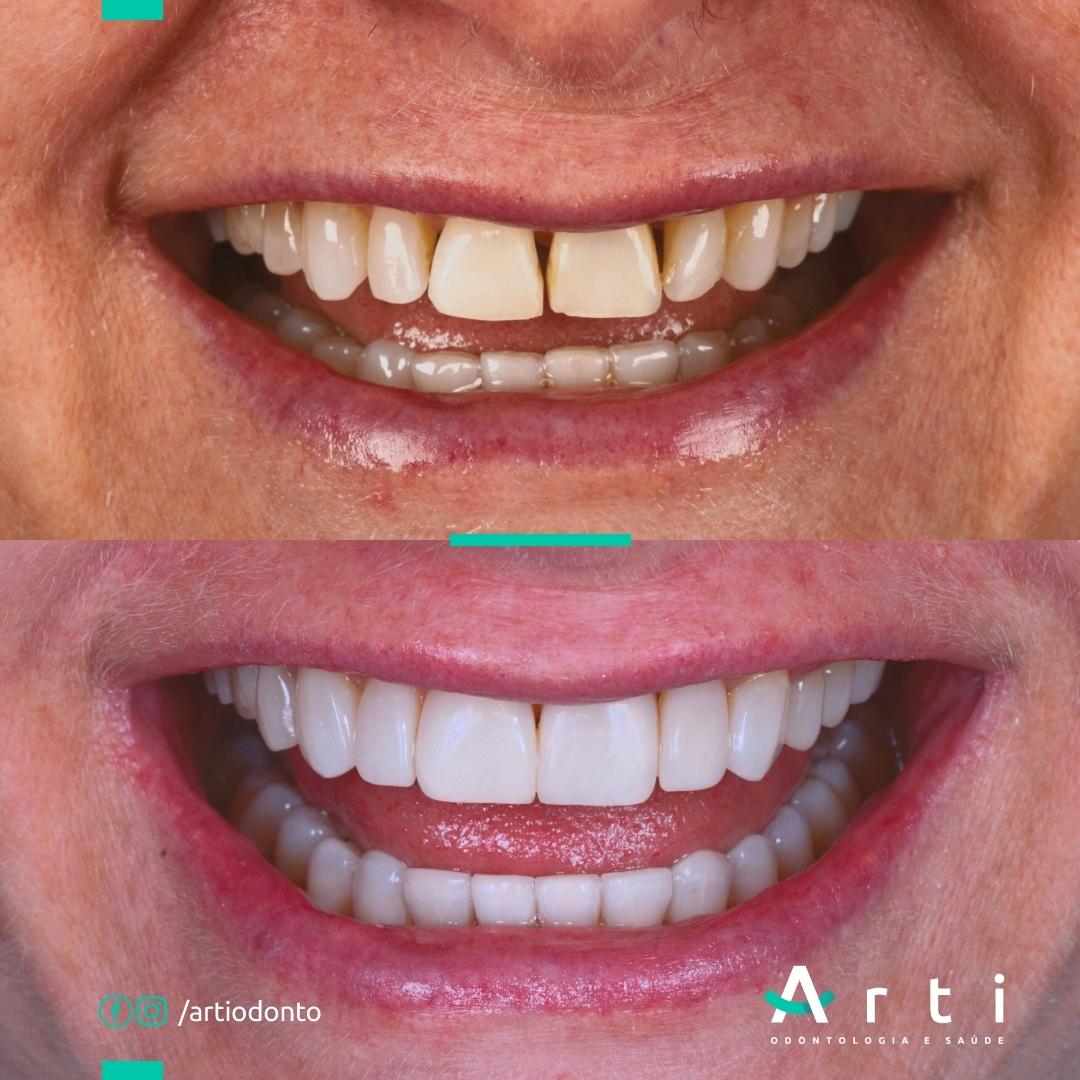 Antes e depois