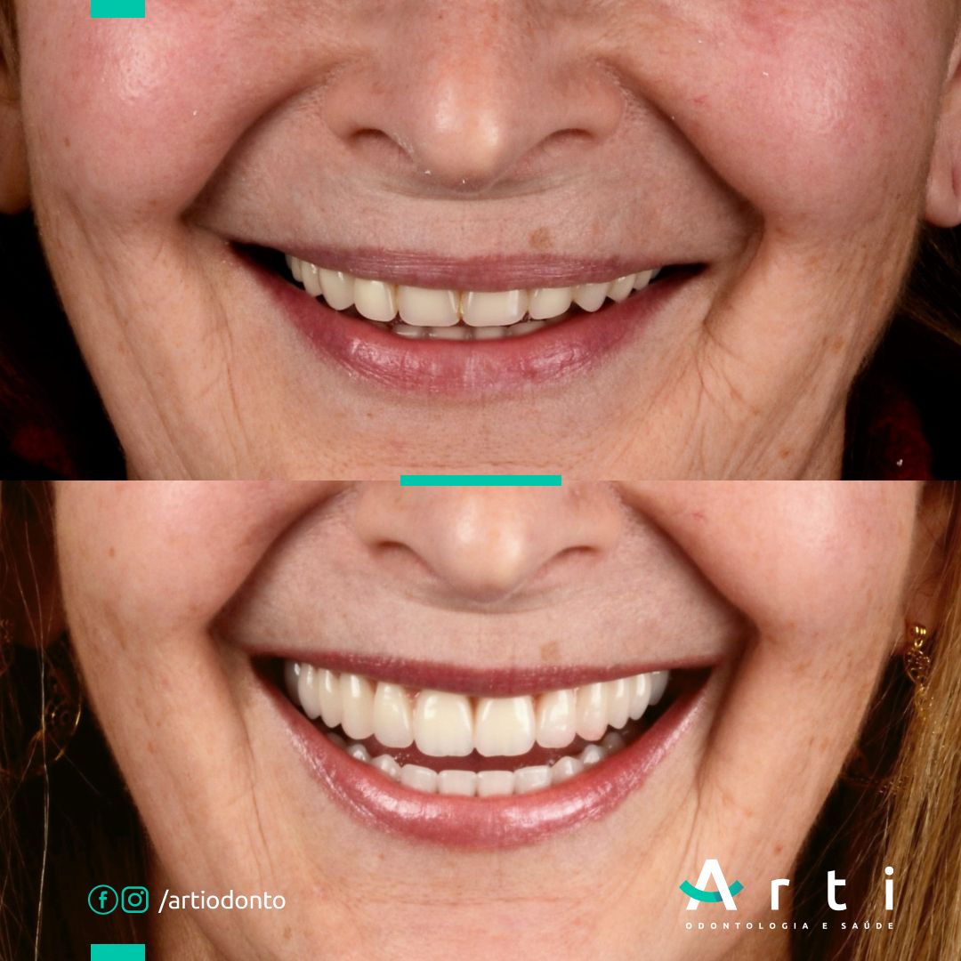 Antes e depois (1)