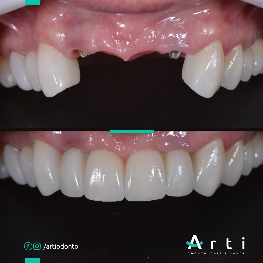 Antes e depois