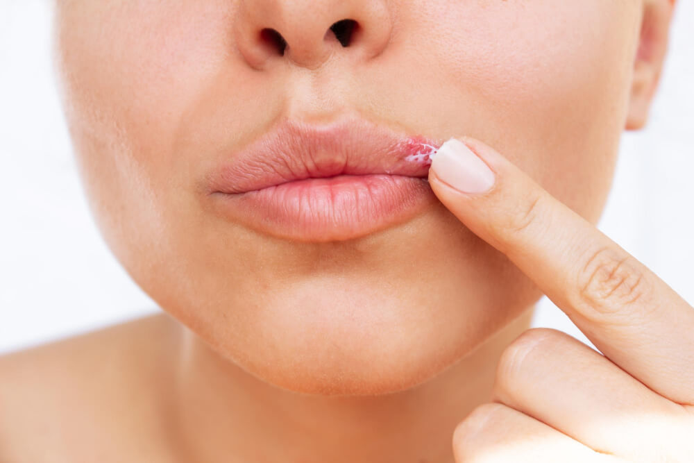 Tratamento de Herpes